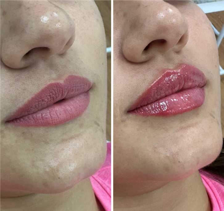 labios con acido hialuronico