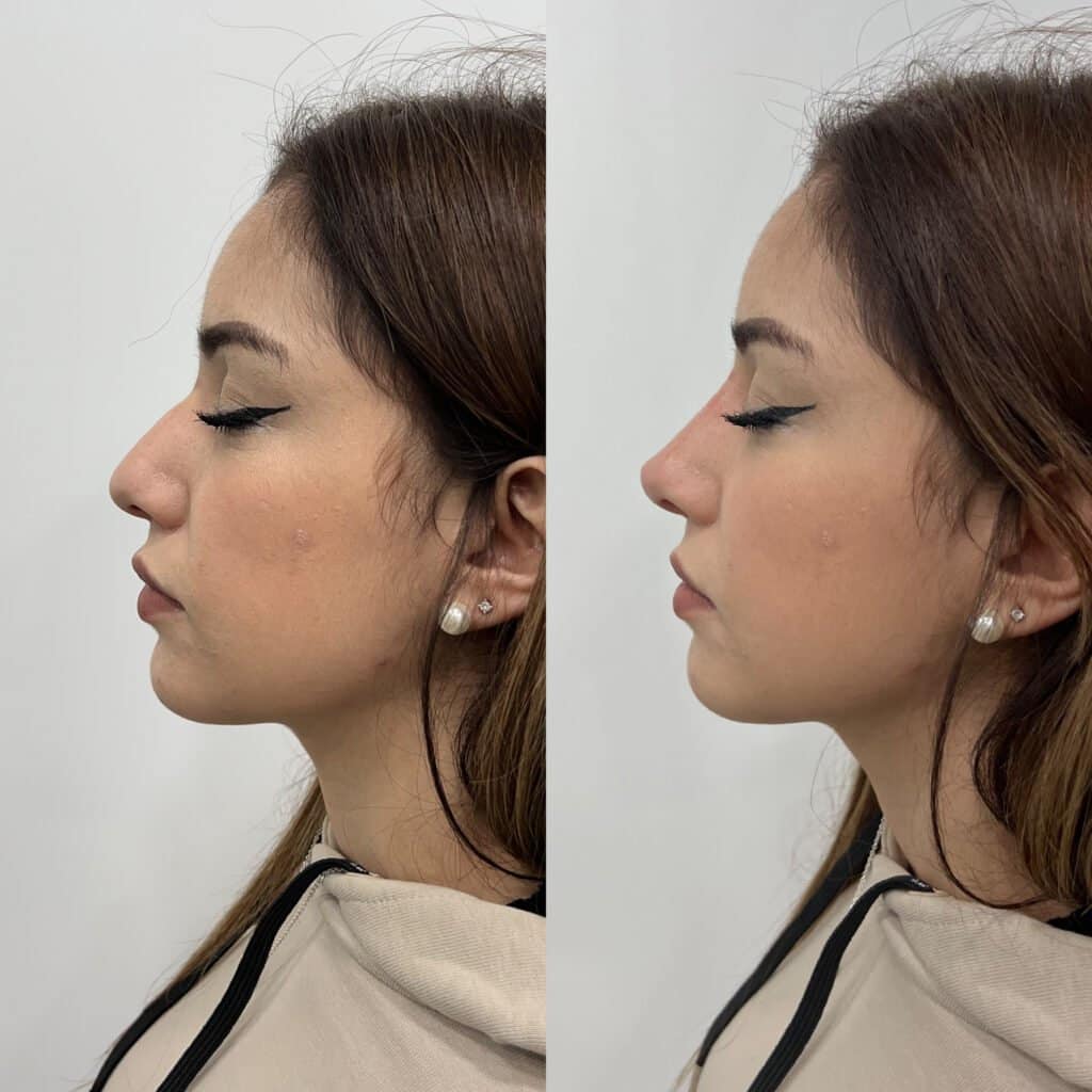 antes despues rinomodelacion